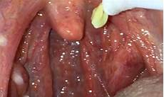 Cotton Buds