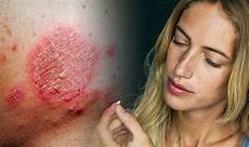 Rash Creams