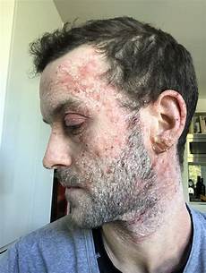 Rash Creams