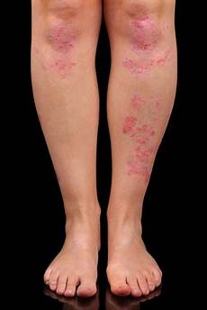 Rash Creams