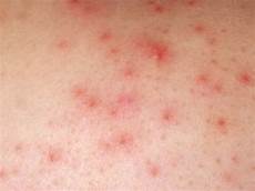 Rash Creams